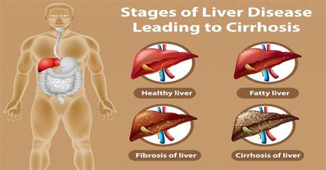 liverosis|Liver Disease: Early Signs, Chronic Symptoms,。